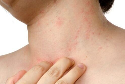 allergia nahaaluste parasiitidega