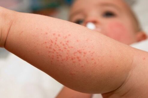 Allergia lapsel kui usside esinemise sümptom
